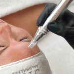 Microneedling behandeling met dermapen bij AV PMU in Wateringen